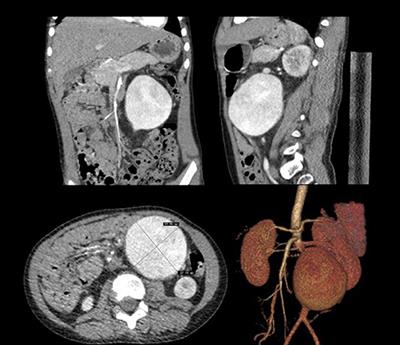 Congenital Abdominal Aortic Aneurysm: A Case Report and Literature Review